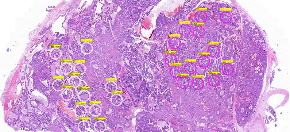 Brain metastasis of prostate cancer with selected intratumoral areas (pink and white circles) for undergoing molecular analyses.