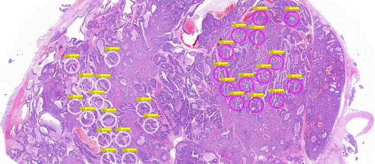 Métastase cérébrale du cancer de la prostate avec des zones intratumorales sélectionnées (cercles roses et blancs) en vue d'analyses moléculaires.